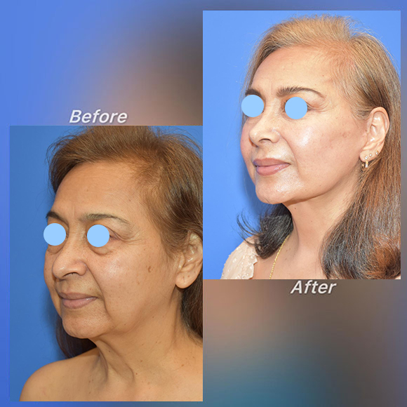 Blefaroplastia