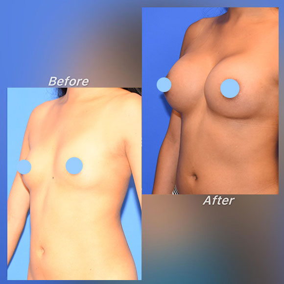 Breast Augmentation