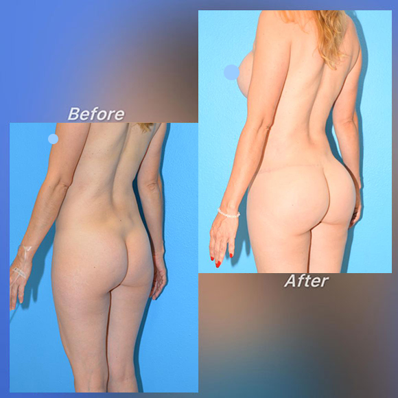 Implante de Glúteos