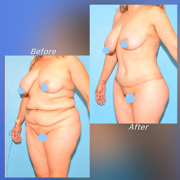 Levantamiento/ Reconstrucción Corporal Por Pérdida Masiva De Peso